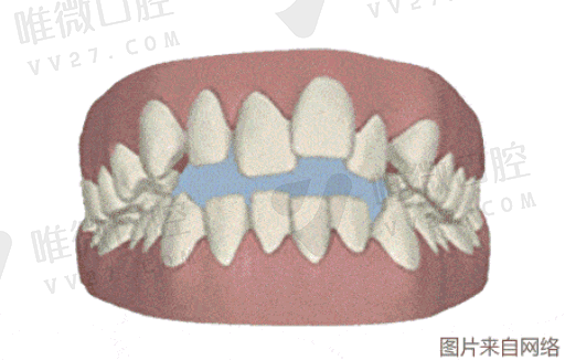 磁伸缩洗牙和超声波有什么不同（磁伸缩与超声波洗牙）(图1)